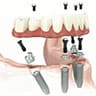 固定式の入れ歯インプラント治療